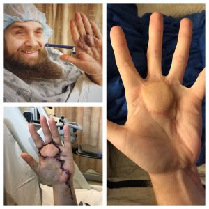 Three images show a before and after of Justin's hand. The first image shows a purple-colored malformation. The second shows Justin holding up his swollen, stitched and bloodied hand. The third shows Justin's hand splayed and the swelling is gone and the purple-colored malformation is replaced with a skin graft.